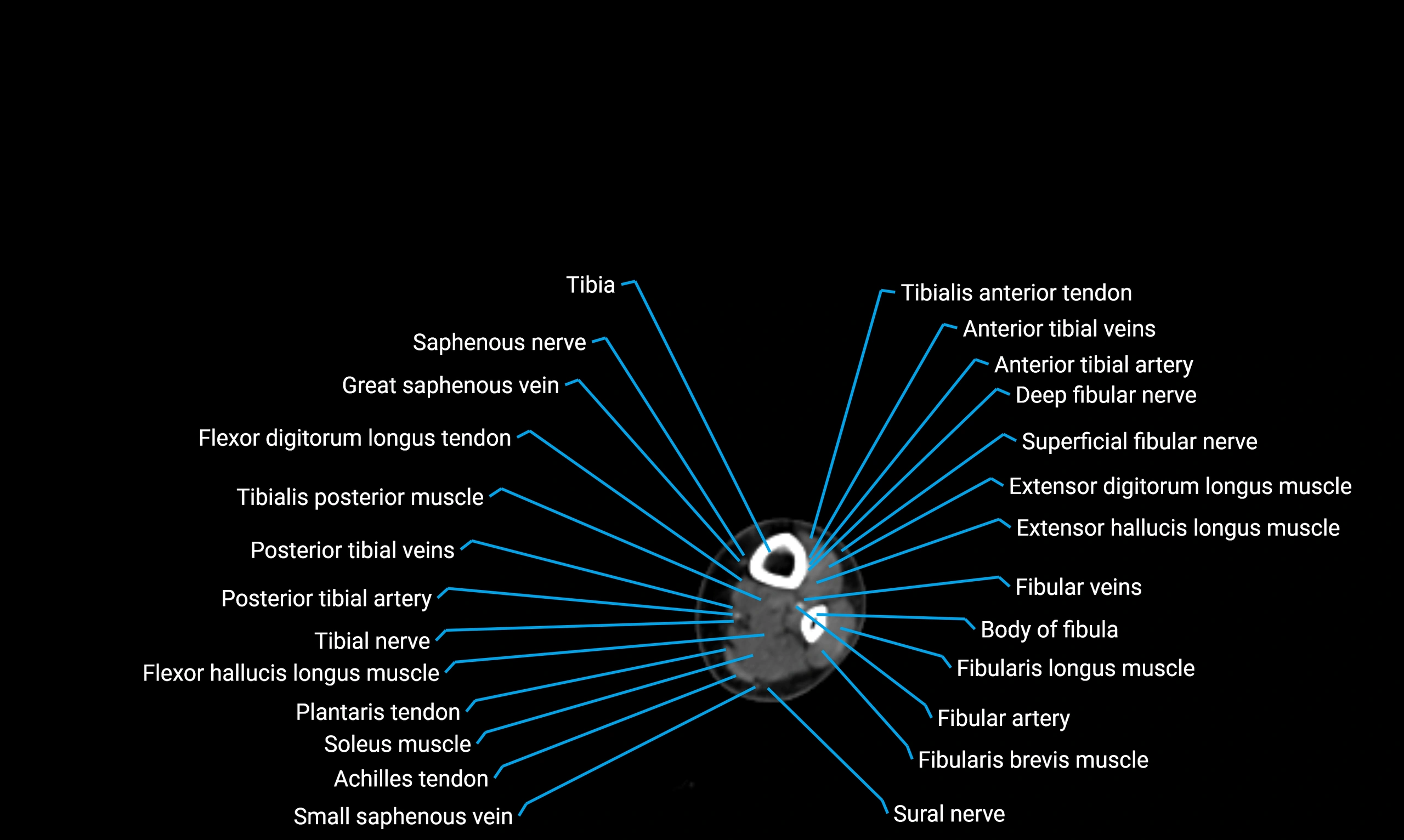 CT lower limb axial cross sectional anatomy labelled image 150 (2).webp